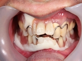 究極の入れ歯治療