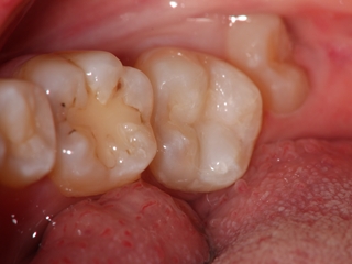 奥歯の治療