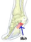 足裏の痛み