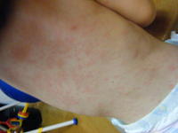 突発性発疹 2009/06/23 14:03:45