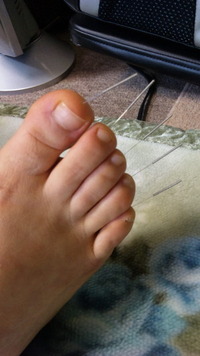 鍼治療 2011/11/15 19:34:24