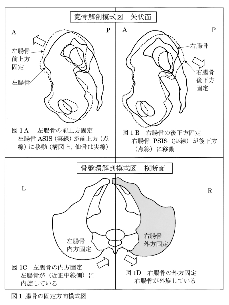図1　腸骨の固定方向模式図